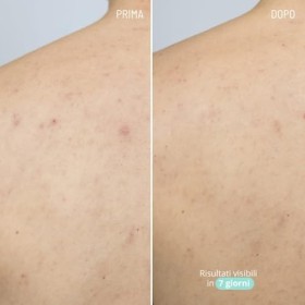 Freshly Cosmetics Sérum contre lacné pour le corps Azelaic Active Body Treatment, 100ml