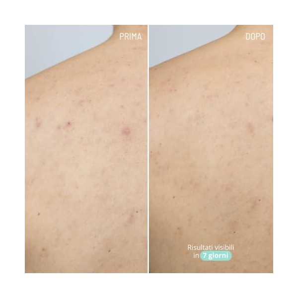 Freshly Cosmetics Sérum contre lacné pour le corps Azelaic Active Body Treatment, 100ml