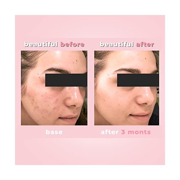 Biotrade Lacné Outtm Tonique ratifiant 60 ml Élimine et contrôle de ldes, Matifier la peau, réduit les Éruptions cutanées, 