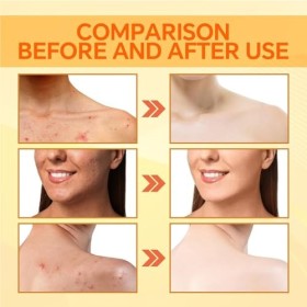 Savon à Lacide Kojique,Barre de Savon au Curcuma avec Acide Kojique,Savon à Lacide Kojique au Curcuma,Visage Barre de Savon