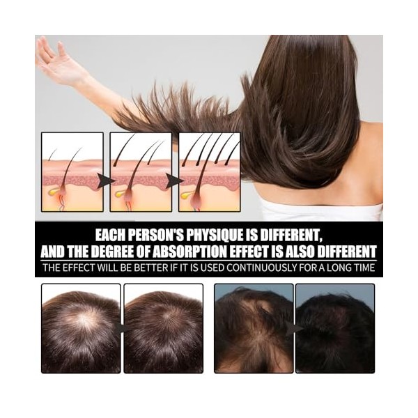 Tkekruh 2PC Sérum De Croissance Capillaire 30ml, Hair Growth Oil, Traitement De Conditionnement Profond, Anti-Chute Cheveux, 