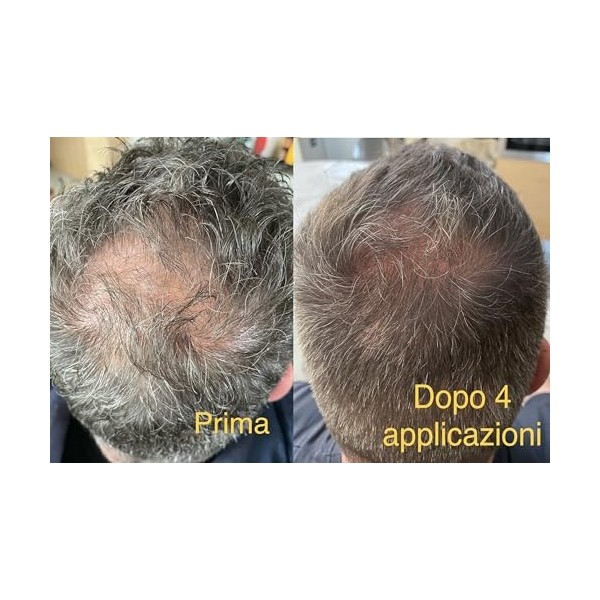 Huile pour les cheveux - Prévention de la chute - Revitalisant - Formule innovante