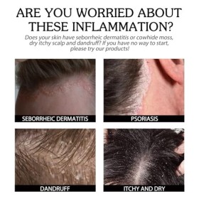 Crème pour la Dermatite Séborrhéique,Traitement du Cuir Chevelu Psoriasis,Dermatite Séborrhéique,Crème Contre le Psoriasis,Cr