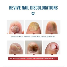 Mycose-Ongles-Pieds, Liquide Naturel Réparateur Soins des ongles, Renforce la Structure de longle Nourrit et Apaise les Ongl