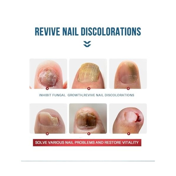 Mycose-Ongles-Pieds, Liquide Naturel Réparateur Soins des ongles, Renforce la Structure de longle Nourrit et Apaise les Ongl