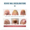 Mycose-Ongles-Pieds, Liquide Naturel Réparateur Soins des ongles, Renforce la Structure de longle Nourrit et Apaise les Ongl