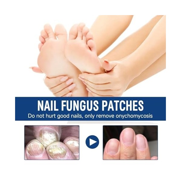 Soin intensif des ongles pour ongles des pieds - Favorise la santé des ongles et renforce les ongles épais - Formule de souti