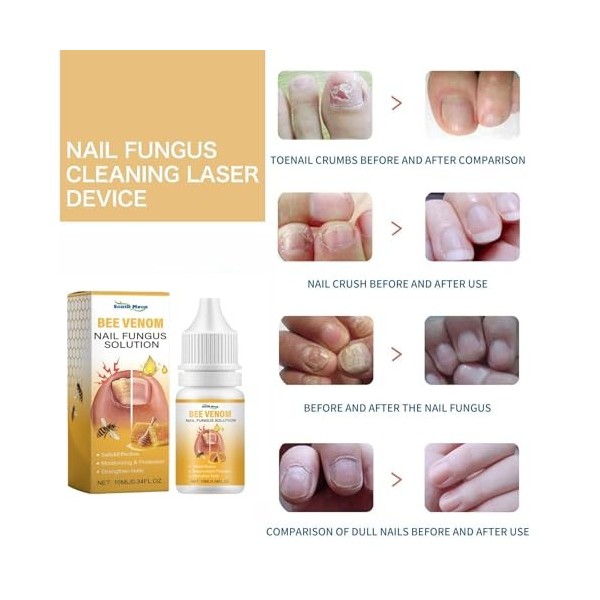 Solution apaisante pour ongles au venin dabeille, sérum de traitement des ongles au venin dabeille, sérum de croissance et 