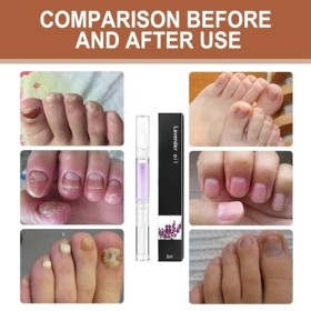 Stylo de croissance des ongles, stylo de soin des ongles, stylo à essence de croissance rapide, huile pour ongles, stylo de r