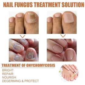 Bee V-enom Sérum de traitement des ongles, sérum de traitement des ongles, sérum apaisant pour ongles Bee V-enom, sérum répar