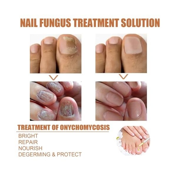 Bee V-enom Sérum de traitement des ongles, sérum de traitement des ongles, sérum apaisant pour ongles Bee V-enom, sérum répar