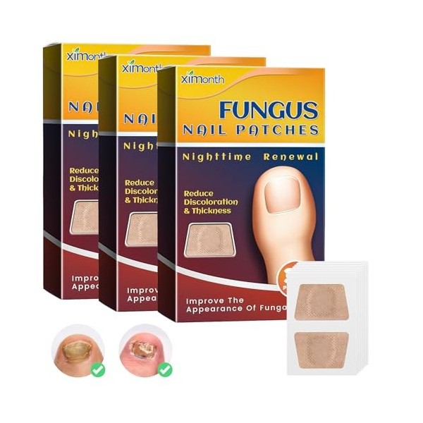 96 Pièces Pansements pour Ongles Mycoses Patch Correcteur Dongles Dorteils Patchs de Réparation de Longle pour Ongles Abîm