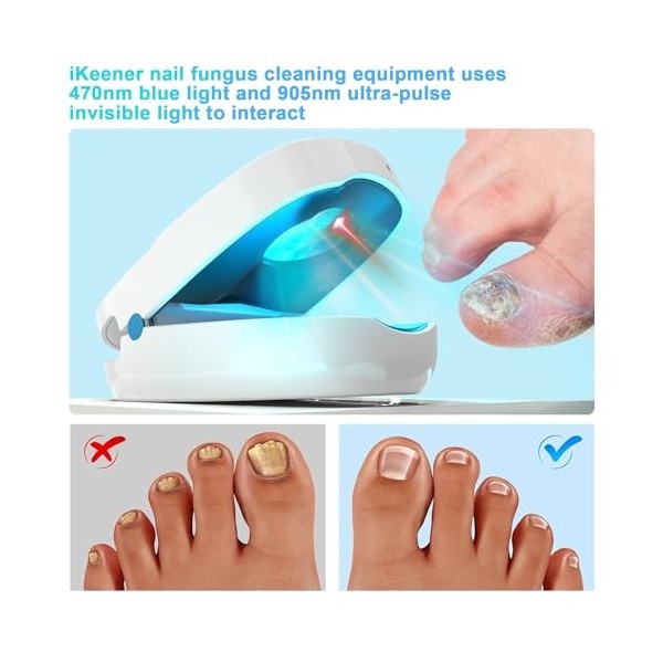 iKeener Dispositif de champignon des ongles,produits rechargeables de soins des ongles et des pieds, appareil de nettoyage de