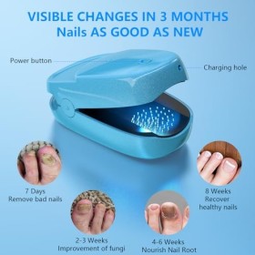 KTS Appareil de traitement des champignons des ongles, thérapie au laser portable pour les champignons des ongles, entretien 