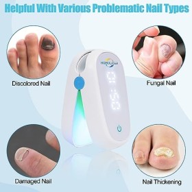 Dispositif Traitement Laser Champignons Ongles,Appareil Traitement Laser Mycose Ongles,Dissolvant Ongles Usage Domestique San
