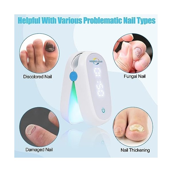 Dispositif Traitement Laser Champignons Ongles,Appareil Traitement Laser Mycose Ongles,Dissolvant Ongles Usage Domestique San