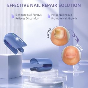 iKeener Appareil Traitement Laser Mycose Ongle Pied, FDA Approuvé Pied Traitement Soin Ongles pour Ortho Vital Mycose, 470nm 