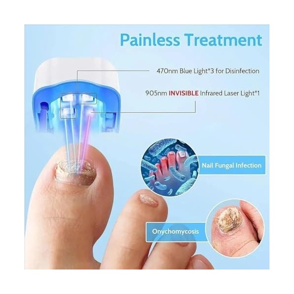 Laser ongle,Traitement Mycose Ongle Pied,Appareil Traitement Laser Mycose Ongles Pied,Amélioration des Ongles Abîmés,Pour les