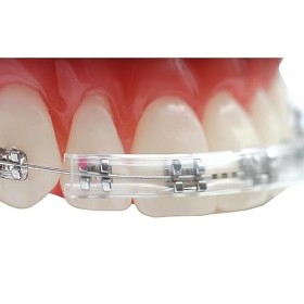 Orthodontique Bretelles Confortables Protection des joues Lèvres Soulagement de la douleur des orthèses Transparent 