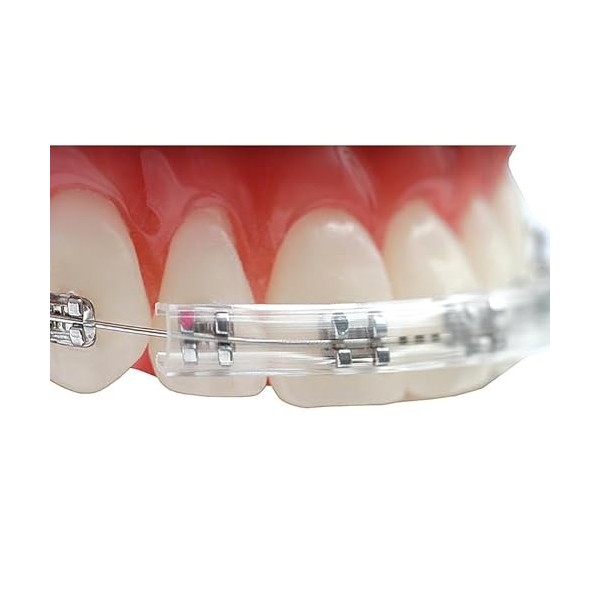 Orthodontique Bretelles Confortables Protection des joues Lèvres Soulagement de la douleur des orthèses Transparent 
