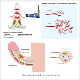 Radial Shock Wave Appareil Thérapie dysfonction érectile ED Soulagement physique Douleur