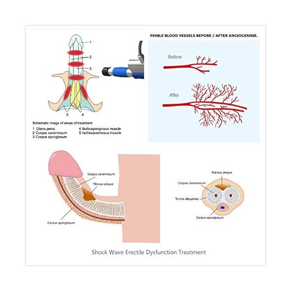 La dysfonction érectile ED de thérapie de machine donde de choc radiale pneumatique améliore lérection