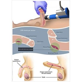 thérapie par machine à ondes de choc radiales extracorporelles dysfonction érectile masculine ED améliorer lérection des hom
