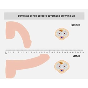 Le dispositif de thérapie par ondes de choc radiales RSWT améliore la dysfonction érectile et stimule lérection