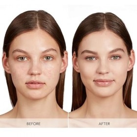 MEITREND Système de micro-infusion dacide hyaluronique, kit de micro-aiguilles, micro-infusion visage, système dinfusion de