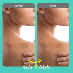 Crème de soin des cicatrices en silicone pour cicatrices : Scar Gel & Scar Removal Cream - Solution de soin pour cicatrices f