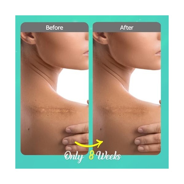 Crème de soin des cicatrices en silicone pour cicatrices : Scar Gel & Scar Removal Cream - Solution de soin pour cicatrices f