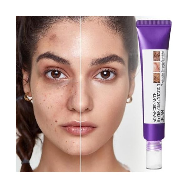 Tyinerc Crème Anti-Taches pour le Visage - 20g Hydratant Visage Doux | Lotion Hydratante, Produit pour lAtténuation des Impe