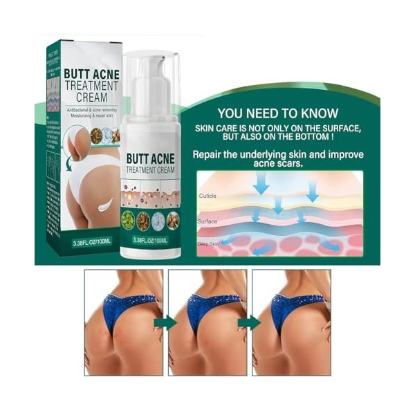 100ml Crème Dissolvant de Boutons pour les Fesses, Crème pour les Boutons des Fesses, Butt Treatment Cream, Lotion de Compens