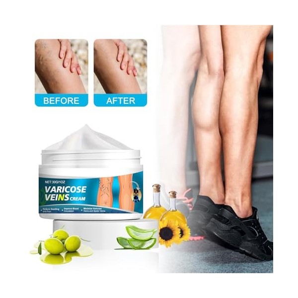 KOAHDE Creme Anti Varices Crème pour Varices,Varices Crème,Varices Jambes Crème,30G,1PC