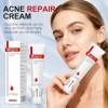 Anti-acné gel 25g, Crème Visage Anti-Acné, Soin Localisé pour visage Hydrate Pendant, Réduit Les Imperfections et les Dacné,