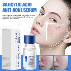 Lotion De Séchage À Bouton, Solution Zit À Action Rapide, Liquide Hydratant Pour Le Visage, 2,6x6,3 Cm, Séchage Rapide Et Lég