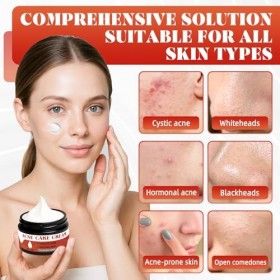 Crème Anti-Acné 35 g, Traitement Localisé Pour le Visage, Crème Hydratante Pour le Visage Adaptée à Tous les Types de Peau, P