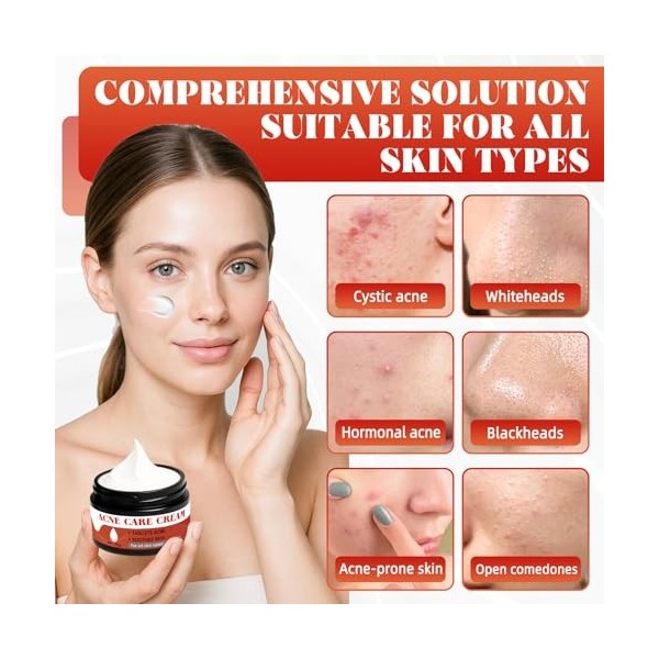 Crème Anti-Acné 35 g, Traitement Localisé Pour le Visage, Crème Hydratante Pour le Visage Adaptée à Tous les Types de Peau, P