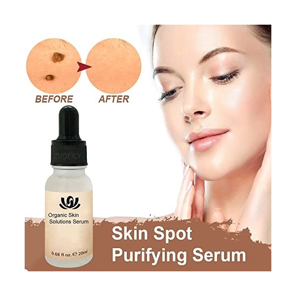 Skin Corrector Clarifying Serum,Organic Skin Spot Solutions Sérum,Sérum Purifiant Anti-taches De Peau Bio, Sérum De Solutions
