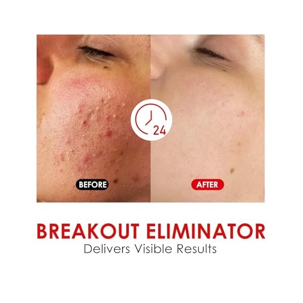 Gel Localisé Anti-Imperfections, Peaux Mixtes à Grasses, Action Anti-Imperfections, Formule Douce, Texture Légère