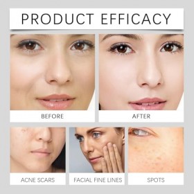 Essence pour le visage contre les taches de rousseur, élimine les taches brunes, antioxydante, illumine le teint, convient à ...