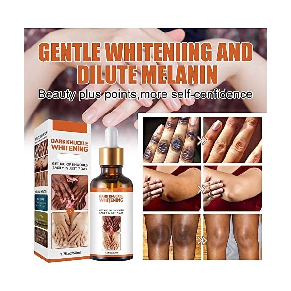 Acanthosis Nigricans Lot de 3 huiles thérapeutiques pour corriger les taches sombres, traitement de lacanthose nigricans, él ...