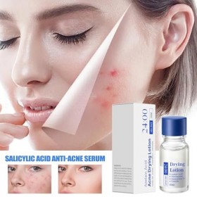 Lotion sèche pour boutons - 10 ml - Solution de séchage rapide des boutons Zit - Crème hydratante pour les imperfections du v...