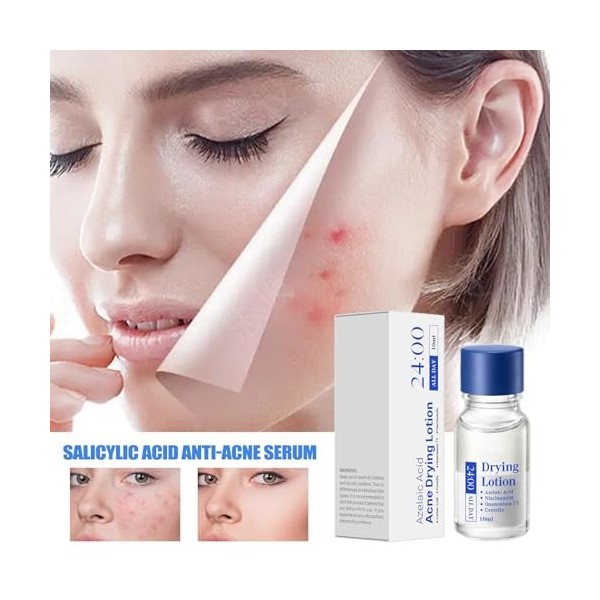 Lotion sèche pour boutons - 10 ml - Solution de séchage rapide des boutons Zit - Crème hydratante pour les imperfections du v...