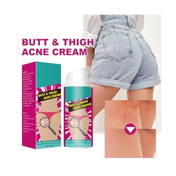 100ml Crème Dissolvant de Boutons pour les Fesses,Butt Treatment Cream,Traitement de Nettoyage des Boutons des Fesses