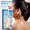 Crème Vitiligo 2pcs – Traitement Intensif des Taches Blanches & Repigmentation | Traitement Des Taches Blanches Sur La Peau R...