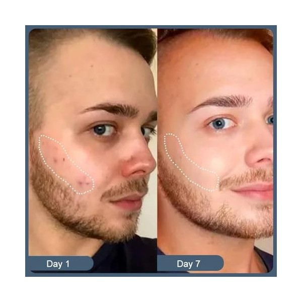 Fengyang® Norse Organics Baume Anti-acné, Redness Relief Balm, Tueur Dacné Et De Rougeurs, Crème Nourrissante Pour La Peau, 