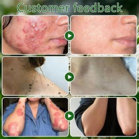 Fengyang® Crème De Soin De La Peau A Lhuile Darbre A Thé, Crème A Lhuile Darbre A Thé, Hydratant Naturel Aux Herbes, Pour