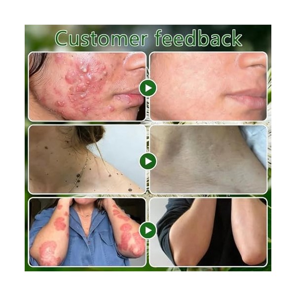 Fengyang® Crème De Soin De La Peau A Lhuile Darbre A Thé, Crème A Lhuile Darbre A Thé, Hydratant Naturel Aux Herbes, Pour