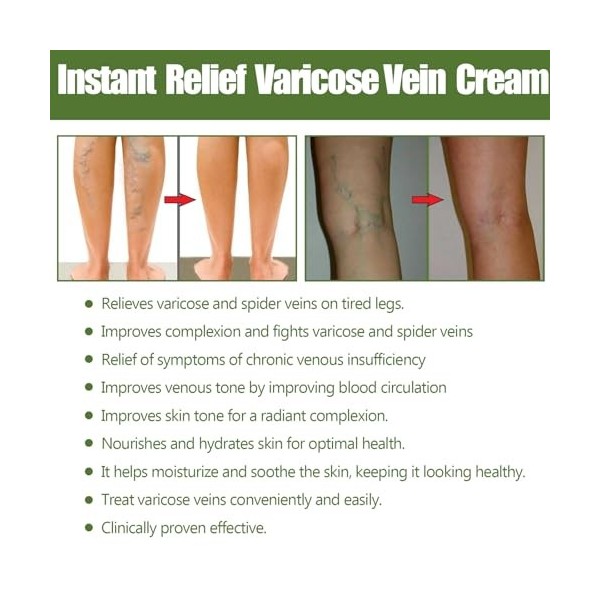 2 Pièces Crème contre les Varicosités, Varicose Vein Repair Cream, Améliore Circulation Soin Jambes Lourdes Relief Veins, Tra